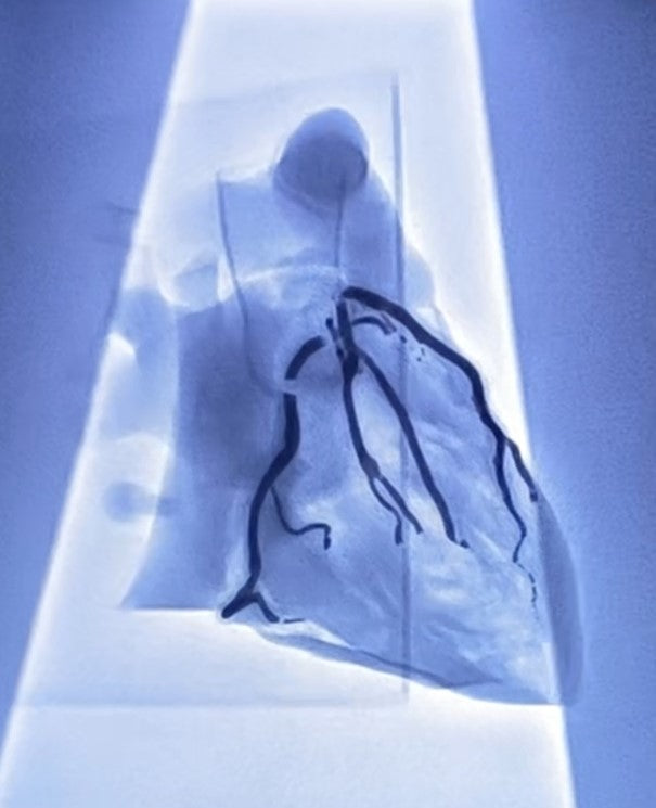 Khawaja Radiopaque Coronary Artery Model