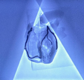 Khawaja Radiopaque Coronary Artery Model